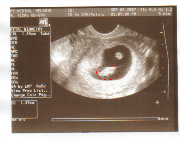 Blob.8weeks.jpg - Hi! I'm little tiny fetus Allie! Can't wait to meet y'all.